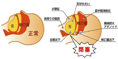 睡眠時無呼吸症候群診療のご案内 | 医療法人裕徳会 港南台病院